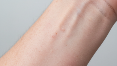 , illustrating potential Early Signs of an Asbestos Rash or other skin Symptoms.